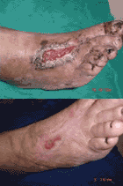 Before & After Pictures of an Ozone Treated Wound Before & After Pictures of an Ozone Treated Wound